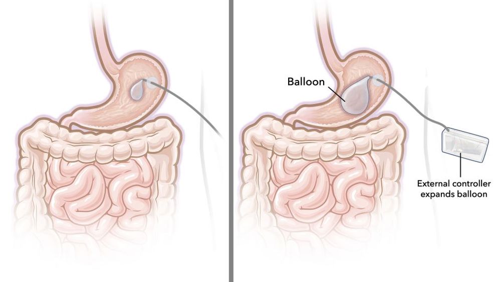 New gastric balloon works on demand